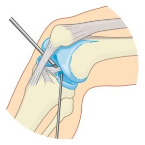 ACL Reconstruction